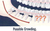 Wisdom Teeth